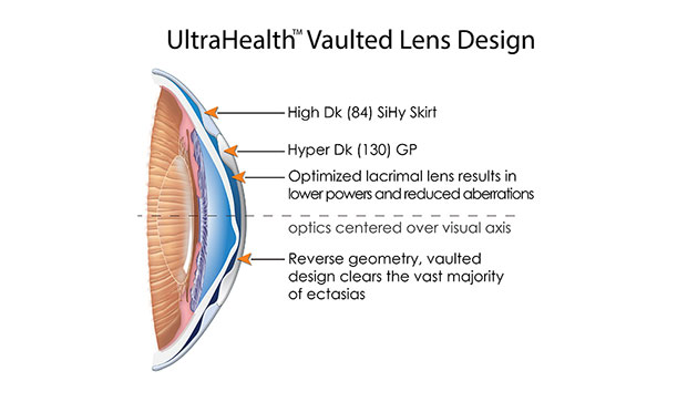ultrahealth vaulted lens design